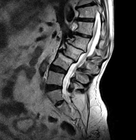 Lumbar Sagittal Varipose 1 MRI Scan